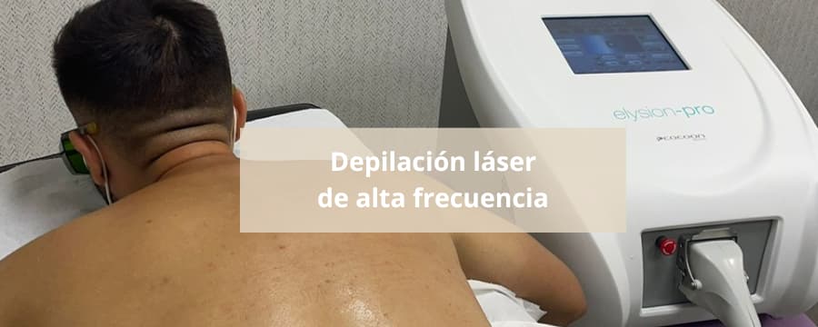 depilacion laser alta frecuencia